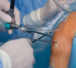 Arthroscopy in vijayawada