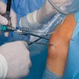 Arthoscopic Adhesiolysis